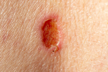 Healing wound from a scraped biopsy site