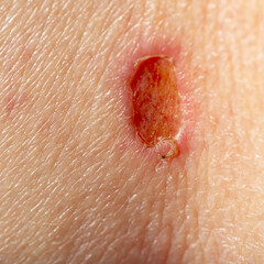 Healing wound from a scraped biopsy site