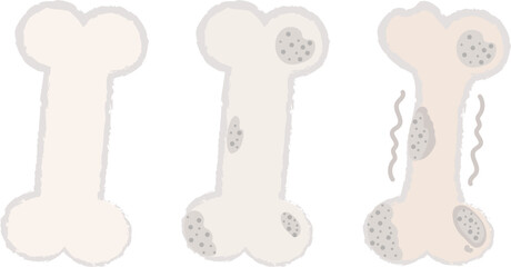 手描きの骨のキャラクターのイラスト 骨粗しょう症