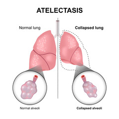Atelectasis collaped lung and alveoli illustration