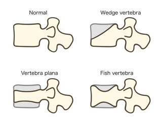 椎骨の形態比較、正常、楔状椎、魚椎、扁平椎のイラスト2