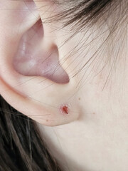 Ear piercing irritation with minor redness and swelling visible on earlobe during healing