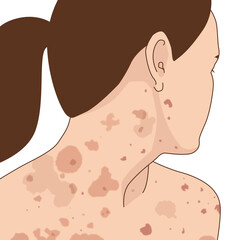 Woman's body medicine allergy rash or atopic illustration on white background close-up