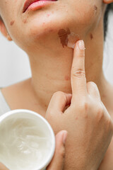 A young Asian woman applying medicative ointment cream for soothing and disguising burn marks on her face while holding the cream pot