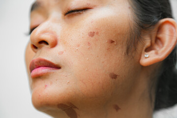 Portrait of an Indonesian woman with skin burn marks of brown spots on her face and neck