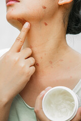 A young Asian woman applying medicative ointment cream for soothing and disguising burn marks on her face while holding the cream pot