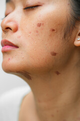Portrait of an Asian woman with skin burn marks of brown spots on her face and neck