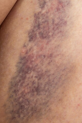A person's arm has a bruise on it