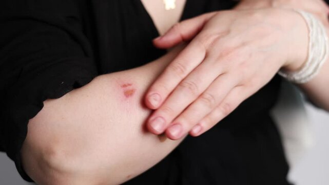 Fresh burn on the arm of a Caucasian female from cooking. 