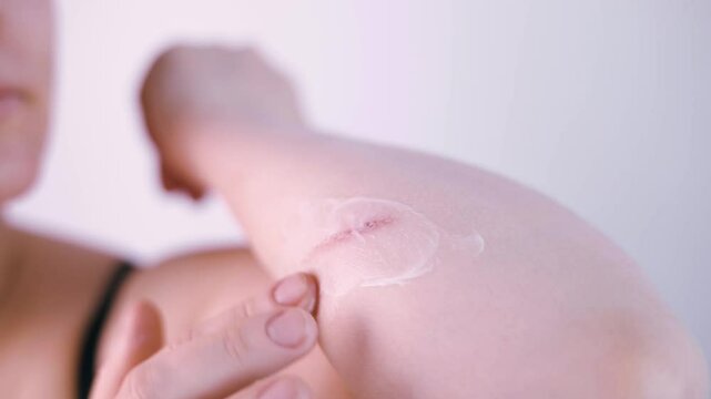 Close-up of unhealthy young woman have skin problems, feels unbearable pain and discomfort. Wound skin burns concept. Dermatology, beauty care from skin problem by medical treatment