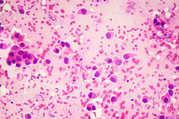 Medical themes: Microscopic image of breast cancer with capillary arrangement