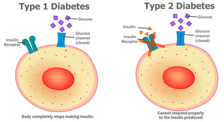 Diabetes types, Type 1, body completely stops making insulin. Type 2  cannot respond properly to the insulin produced. Pancreas, Liver working system, endocrine diseases. Vector illustration