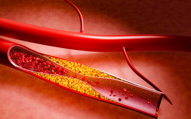 Artery clogged by unhealthy junk food, sugary drinks, and alcohol, illustrating serious cardiovascular risks, atherosclerosis, and heart disease problems in human blood vessels. 3D rendering.