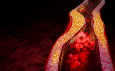 3D medical concept showing artery plaque formation due to high LDL cholesterol, poor nutrition, excessive sugar intake, alcohol consumption, lack of exercise leading to heart disease. 3D rendering