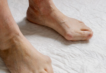 Naklejka premium Feet of an elderly woman with hallux valgus.