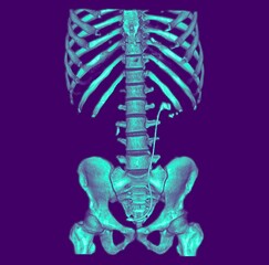 abdomen CT scan 3d rendering showing kidney stone and Dj stent JJ stent (down left) in a urinary system. The stent has been inserted in the patient's ureter to keep it open