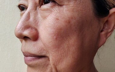 portrait the Flabbiness and flabby skin, swelling and ptosis beside the eyelids, dark spots and blemish, melasma and scar, wrinkles and dullness on the face, health care and beauty concept.