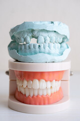 Dental Model and Plaster Cast of Human Teeth