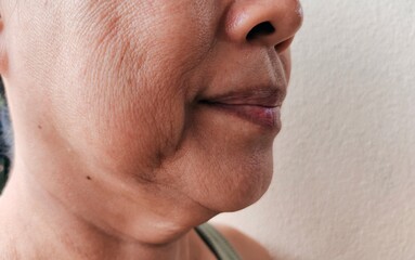 portrait the Flabbiness and wrinkle, Flabby skin and smile lines beside the mouth, dark spots and blemish, scar and freckles, blemishes and melasma, neck wattle and cellulite of the woman.