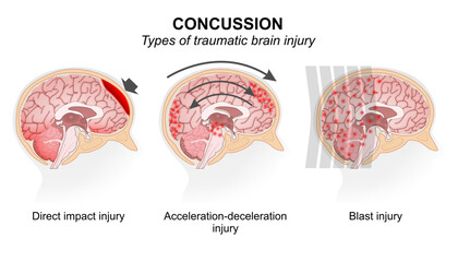 Types of traumatic brain injury (Concussion)