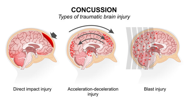 Types of traumatic brain injury (Concussion)