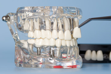 Transparent anatomical dental model showing tooth implants and a veneer being positioned