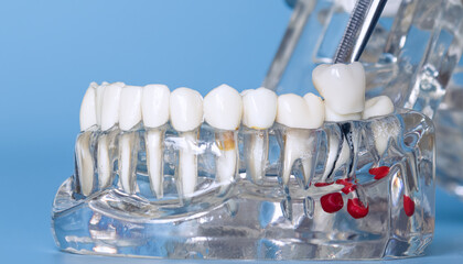Dental implant model showing tooth crown placement