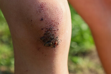 A scraped knee with dried blood and bruises indicates a recent injury. This close-up captures the...