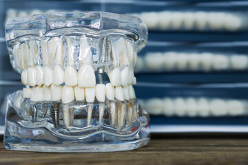 Transparent dental model showing implants and crowns
