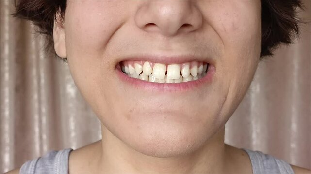 Close-up of the mouth, the smile of a teenage boy. Orthodontic problems. Diastema. The gap between the teeth.