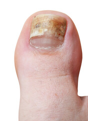 Fungal infection of human toenails close-up isolated on white background.