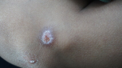 Detailed Close Up Skin with Healing Wound Scar After Injury Trauma