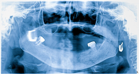 Panoramic dental x-ray of an old person with only two teeth and no tooth of the upper and lower jaw
