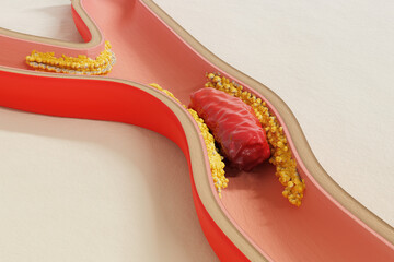 Hyperlipidemia concept. Fat deposits in blood vessels and red blood cell flow. Health care and medical. 3d render.