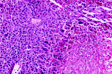 Image of human cells tissue of lung human under the microscope in pathology lab.View in microscopic of squamous cell carcinoma from human cervical cancer, tissue section by H and E