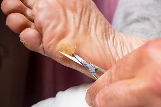 Cutting a sole callus with a silver scissors, soft focus close up