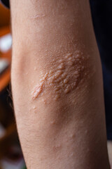 Pustules and visible scars on a child  elbow soft focus close up