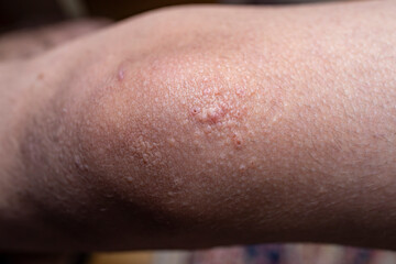 Fototapeta premium Pustules and scars on a childs knee, soft focus close up
