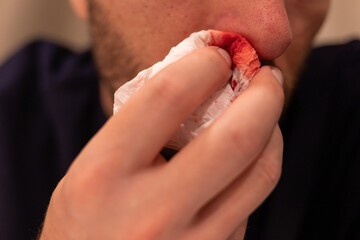 man applies tissue to nose to stop bleeding. nosebleed