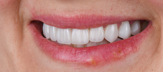 Fototapeta premium ceramic crowns and veneers