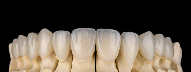 ceramic crowns and veneers