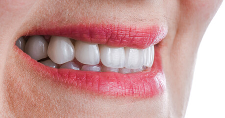 ceramic crowns and veneers