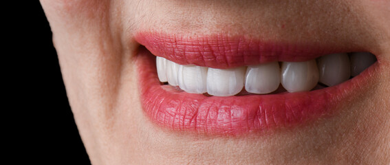 ceramic crowns and veneers