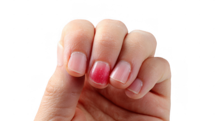 Woman showing injured finger with painful subungual hematoma under fingernail, isolated on transparent background, demonstrating common household injury