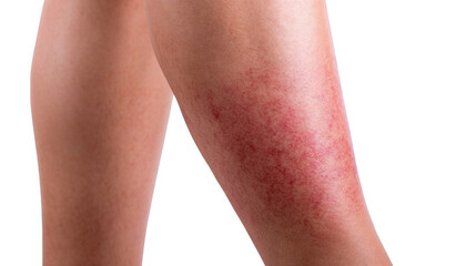 Red rash showing symptoms of cellulitis affecting a woman's leg, isolated on transparent background, ideal for medical and healthcare publications