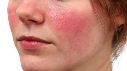 Red rash on woman's face, indicating possible fever, sunburn, allergy, or other skin condition, isolated on transparent background, useful for health and beauty concepts