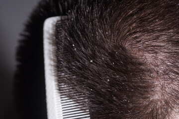 Dermatology shampoo. Dermatitis or eczema. Problem of dandruff. Dandruff hair. Messy hair. Hair with dandruff. Scalp problem, dandruff. Hair disease seborrhea.