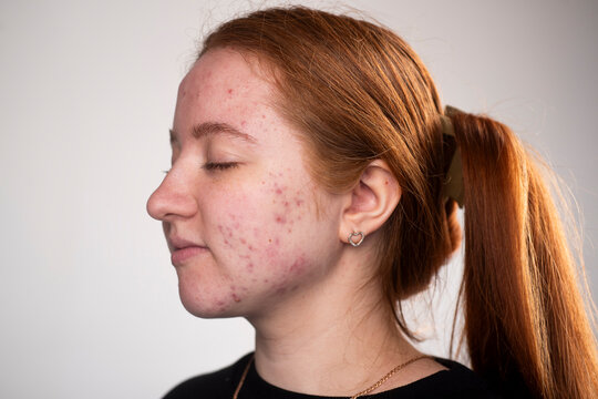 Many pimples. Girl with bad skin. Hormonal acne, puberty. Skin acne background. Closeup acne pimple. Treatment for acne skin. Problem skincare. Pimples, pores, scars. Skincare treatment.