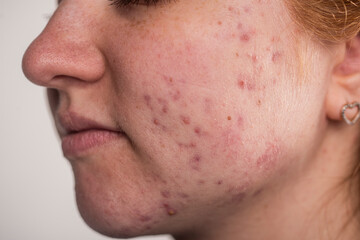 Many pimples. Girl with bad skin. Hormonal acne, puberty. Skin acne background. Closeup acne pimple. Treatment for acne skin. Problem skincare. Pimples, pores, scars. Skincare treatment.