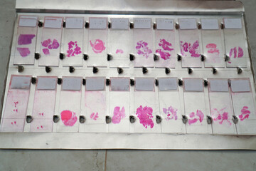 collection of human tissue slides in the anatomical pathology laboratory